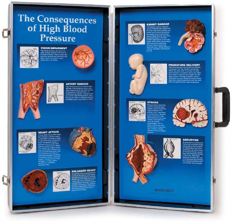 Consequences Of High Blood Pressure Display