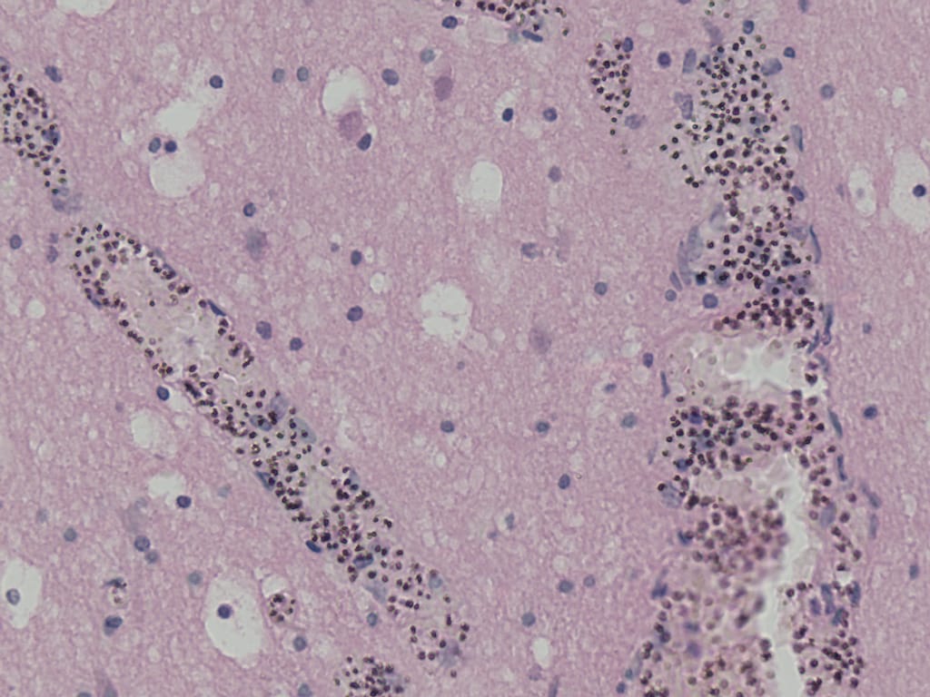 Plasmodium falciparum, Brain, Hematoxylin & Eosin Stained Section Slides
