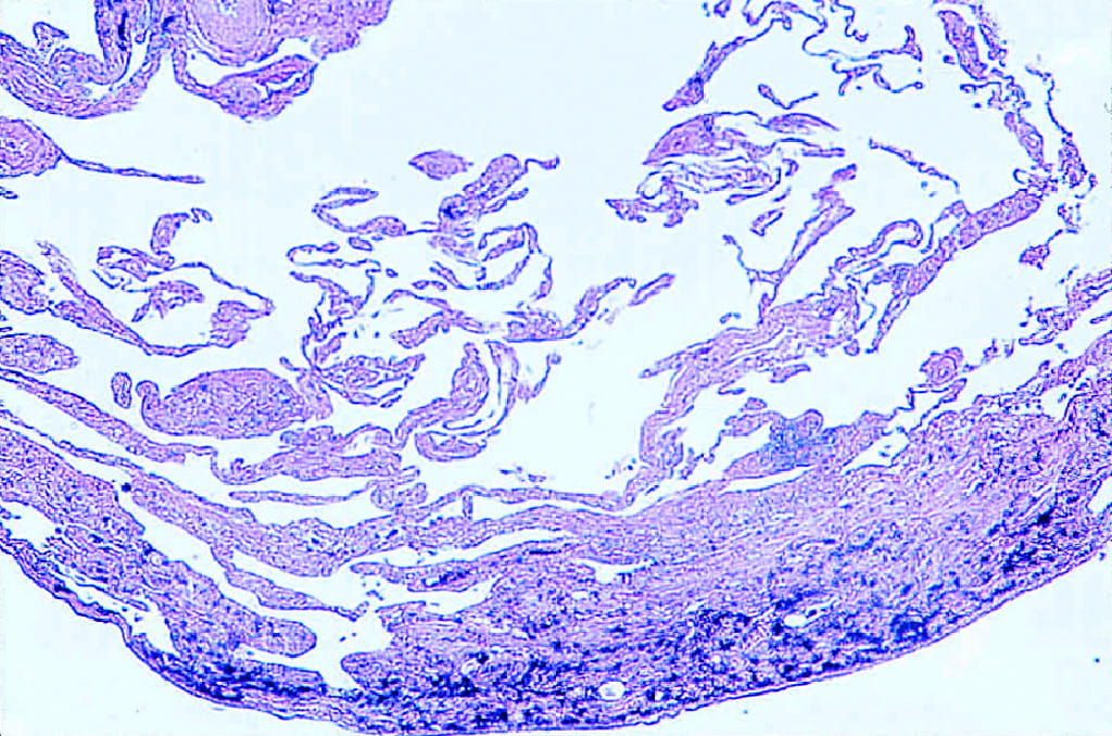 Emphysema