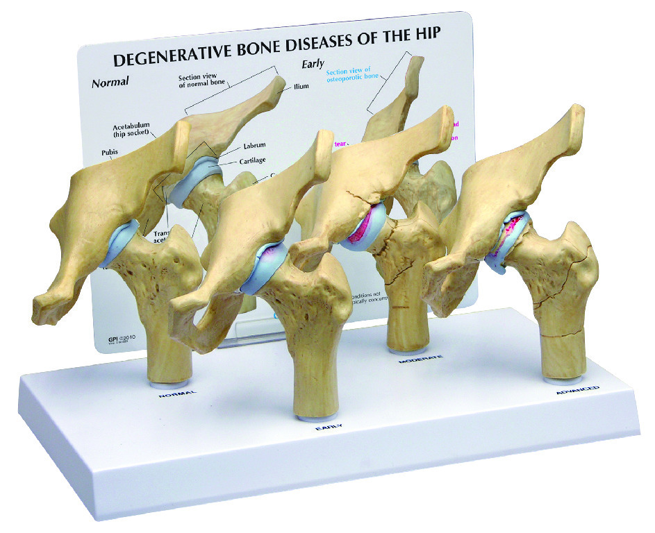 GPI Anatomicals® Arthritic Hip Model
