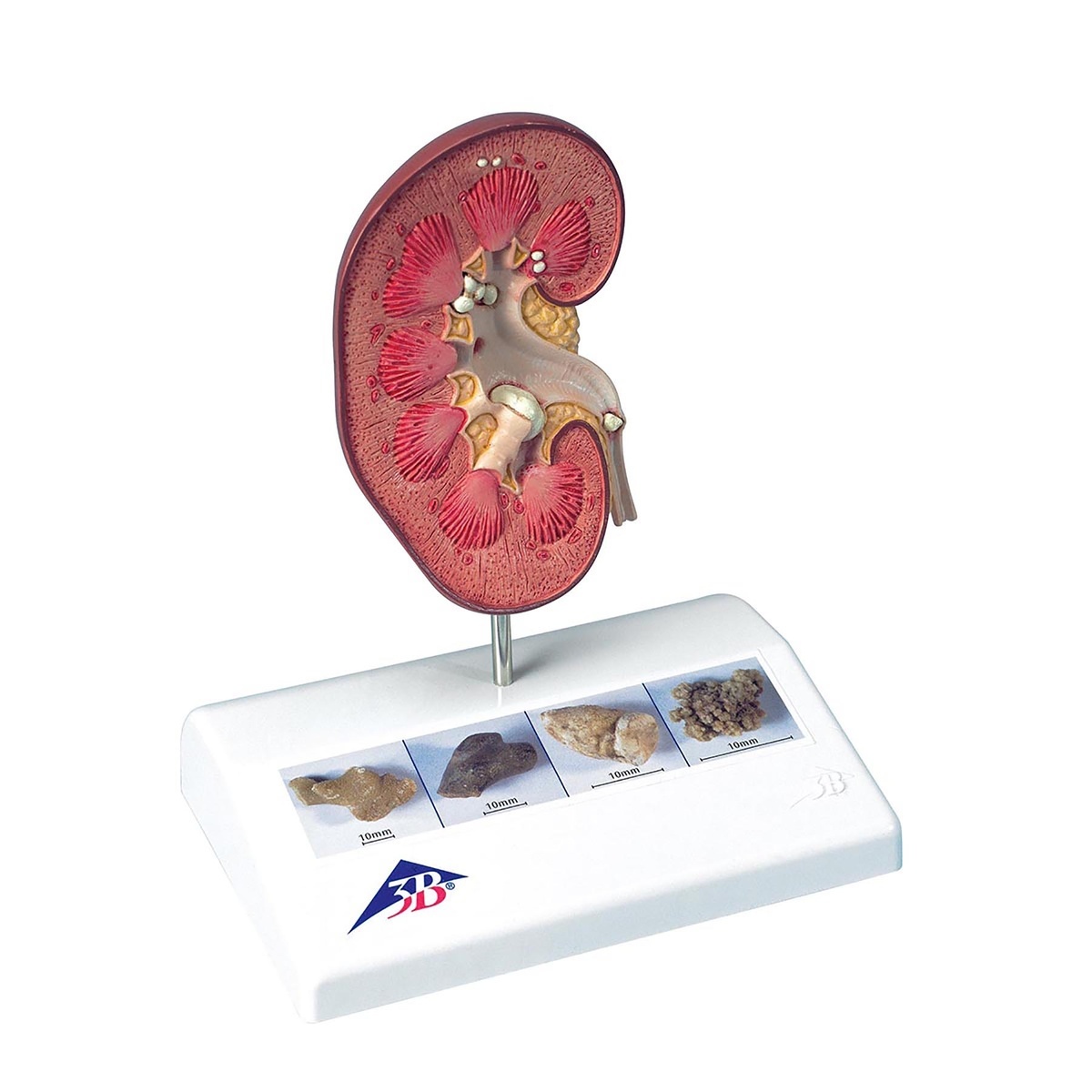 3B Scientific® Kidney Stone Model