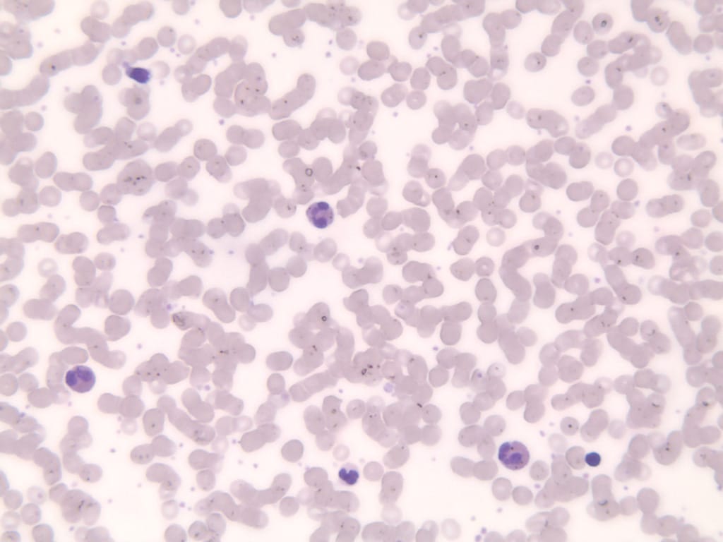 Eosinophilia Slide