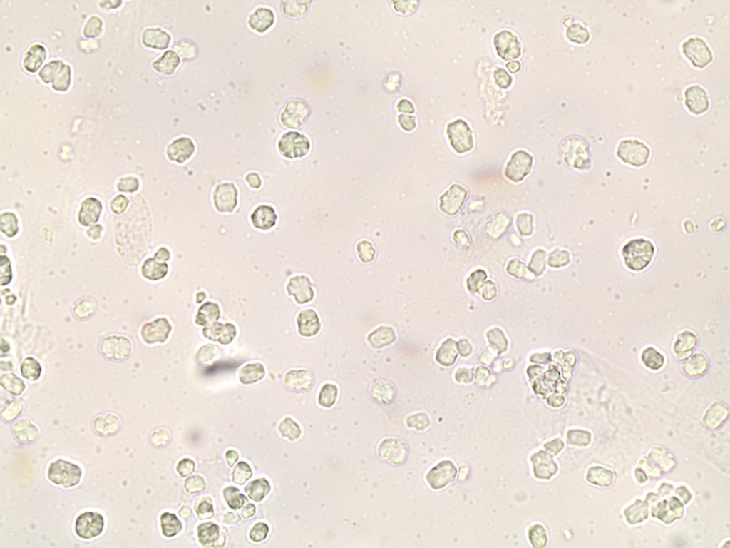 Urine Sediment, Unstained Slide