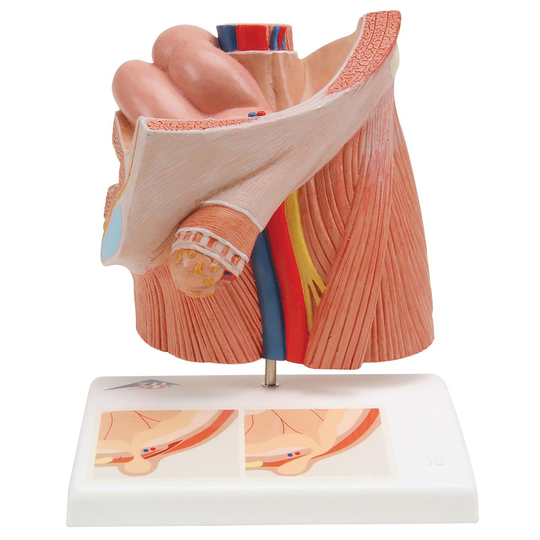 3B Scientific® Inguinal Hernia