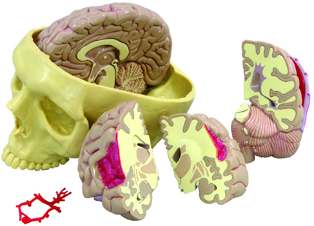 GPI Anatomicals® Brain in Skull Pathologies Model