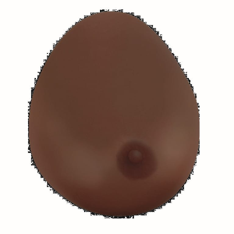 3B Scientific® Breast with Benign Tumor