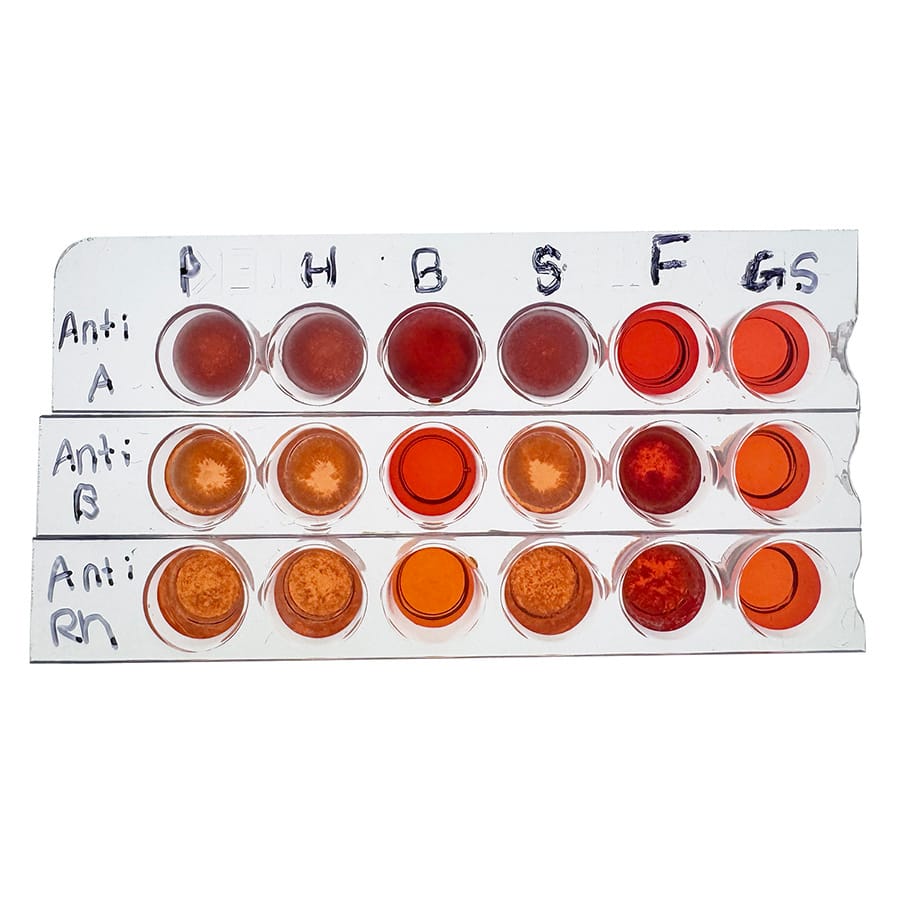 Edvotek® The Science Behind Finding A Perfect Match: Blood Typing For Stem Cell Transplants