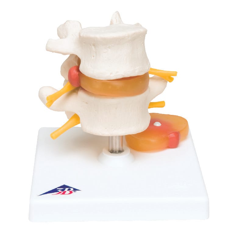 3B Scientific® Lumbar Spine With A Prolapsed Disc
