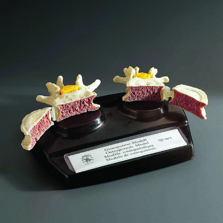 Somso® Osteoporosis Model