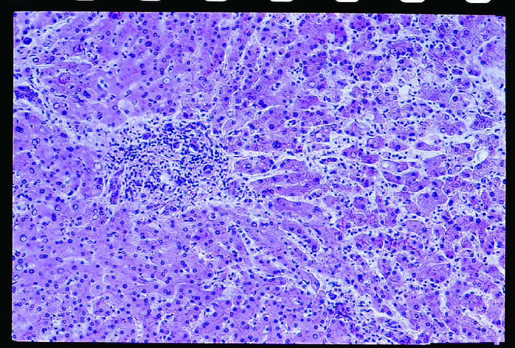 Cirrhosis, Section, Hematoxylin and Eosin Stained Slides