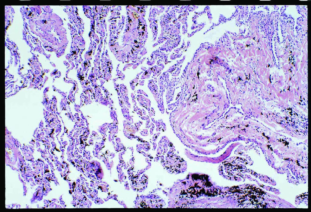 Anthracosis Slide