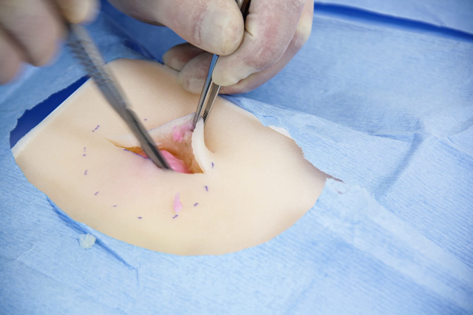 SIM Lipoma Surgical Models