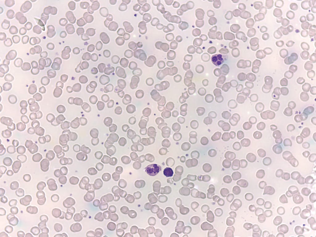 Iron-Deficiency Anemia Slide