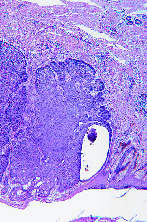 Skin Cancer Slide
