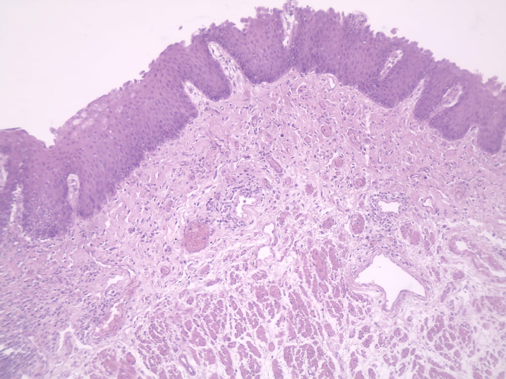 Esophagus, Composite Slide