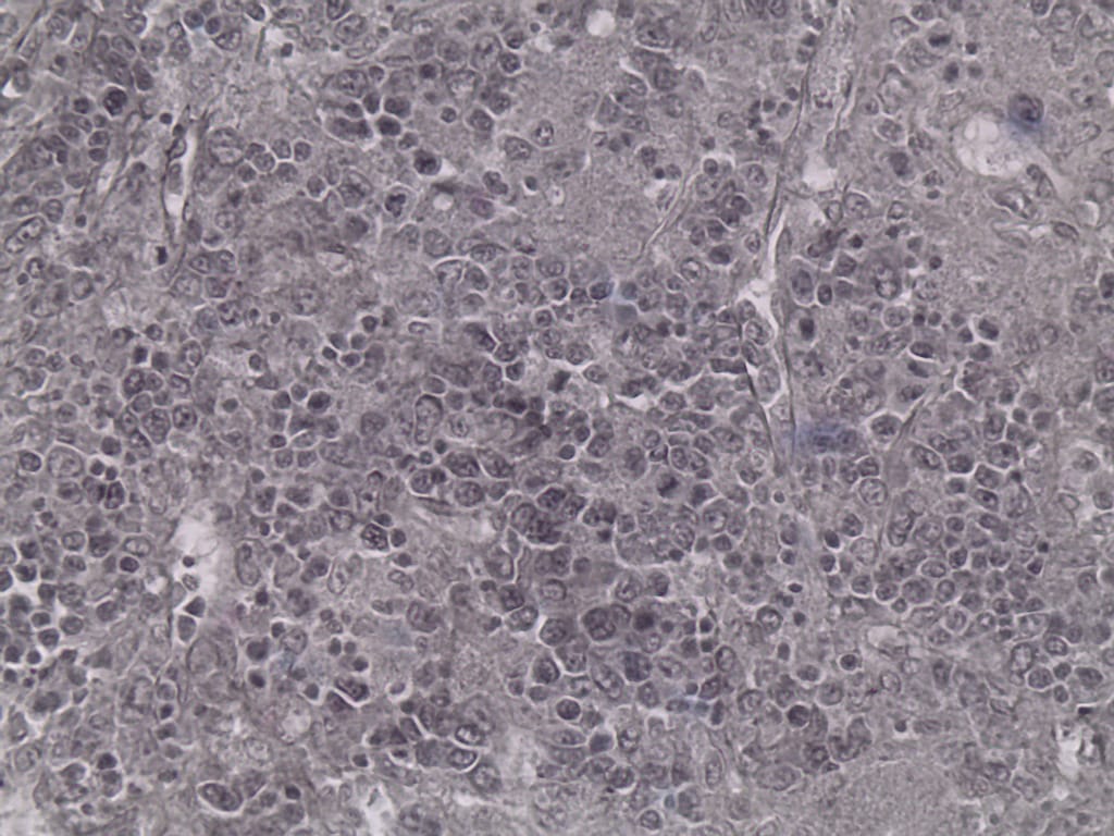 Leishmania donovani, Spleen Slide
