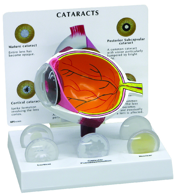 GPI Anatomicals® Cataract Eye Model