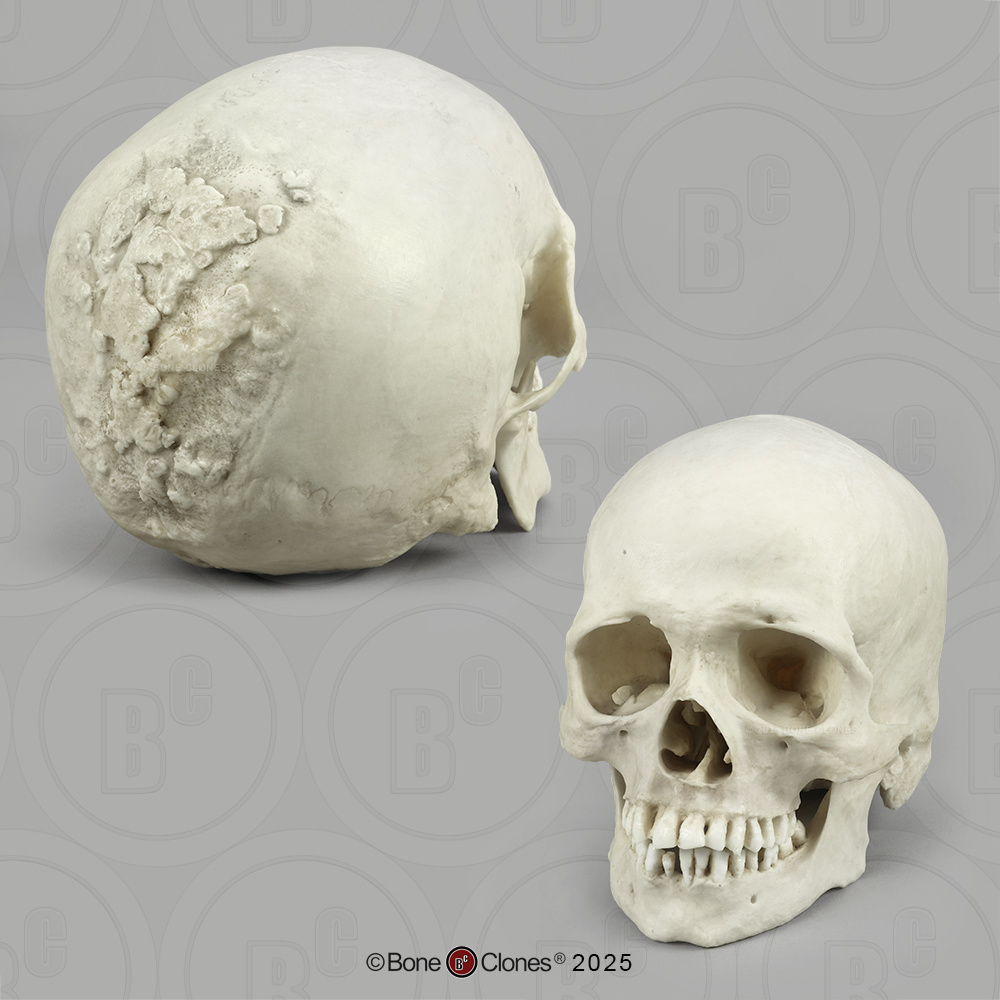 Bone Clones® Human Skull Syphilis