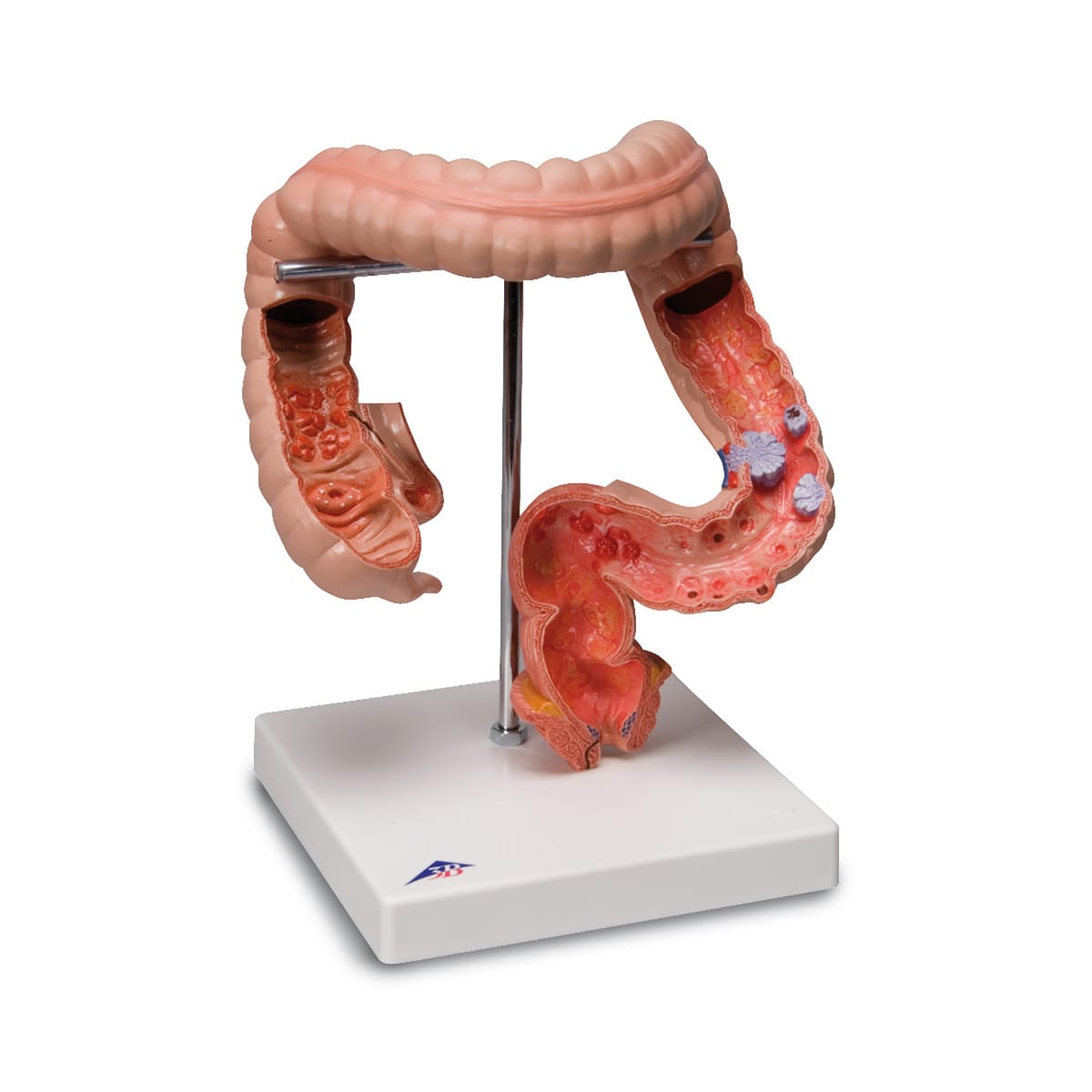 3B Scientific® Intestinal Diseases