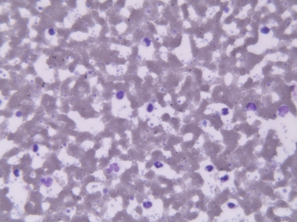 Thrombocytosis Slide