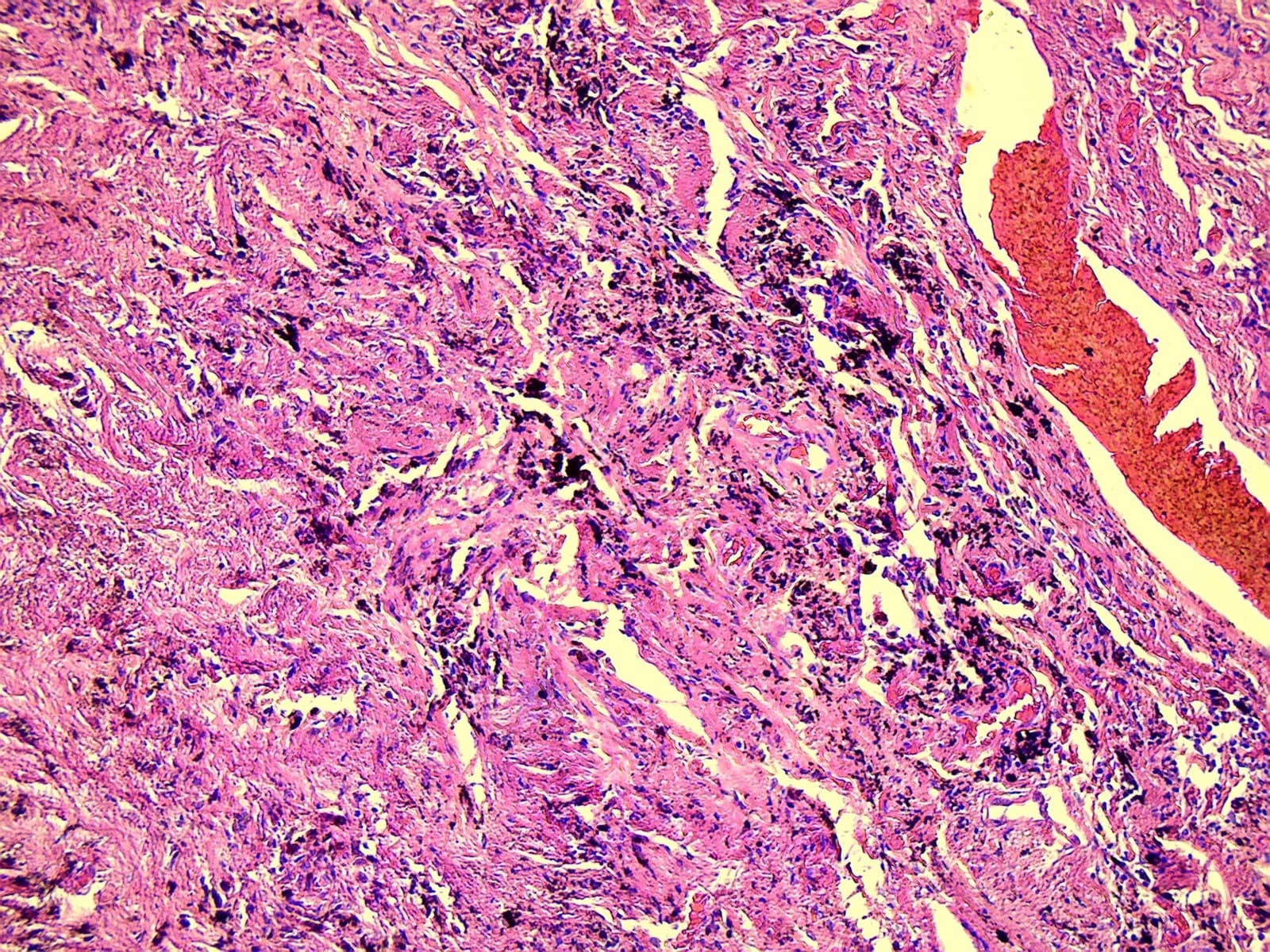 Lung, Tuberculosis (Human) Slide