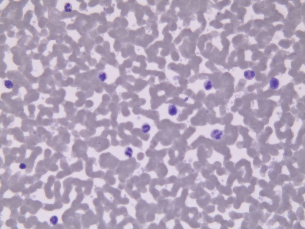 Polycythemia Slide