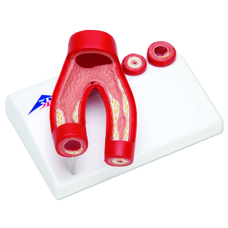 3B Scientific® Arteriosclerosis