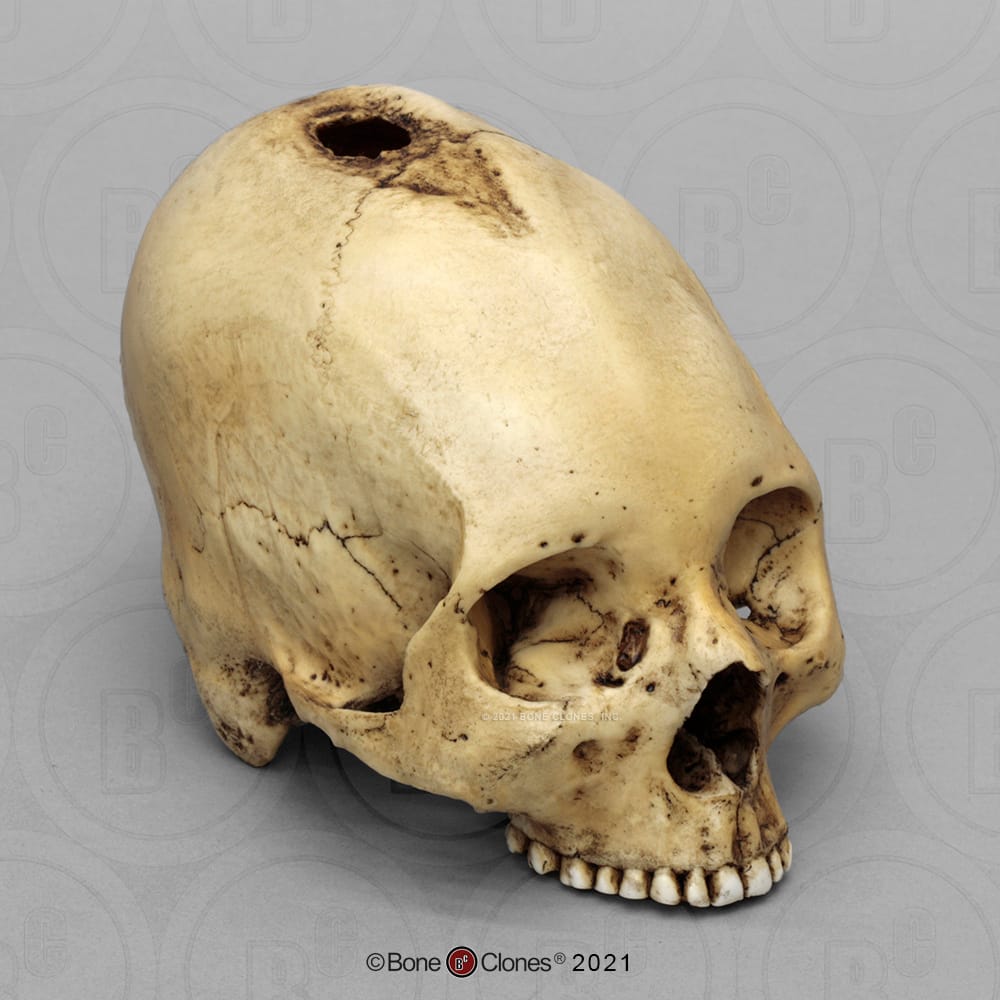 Bone Clones® Human Trephined Skull