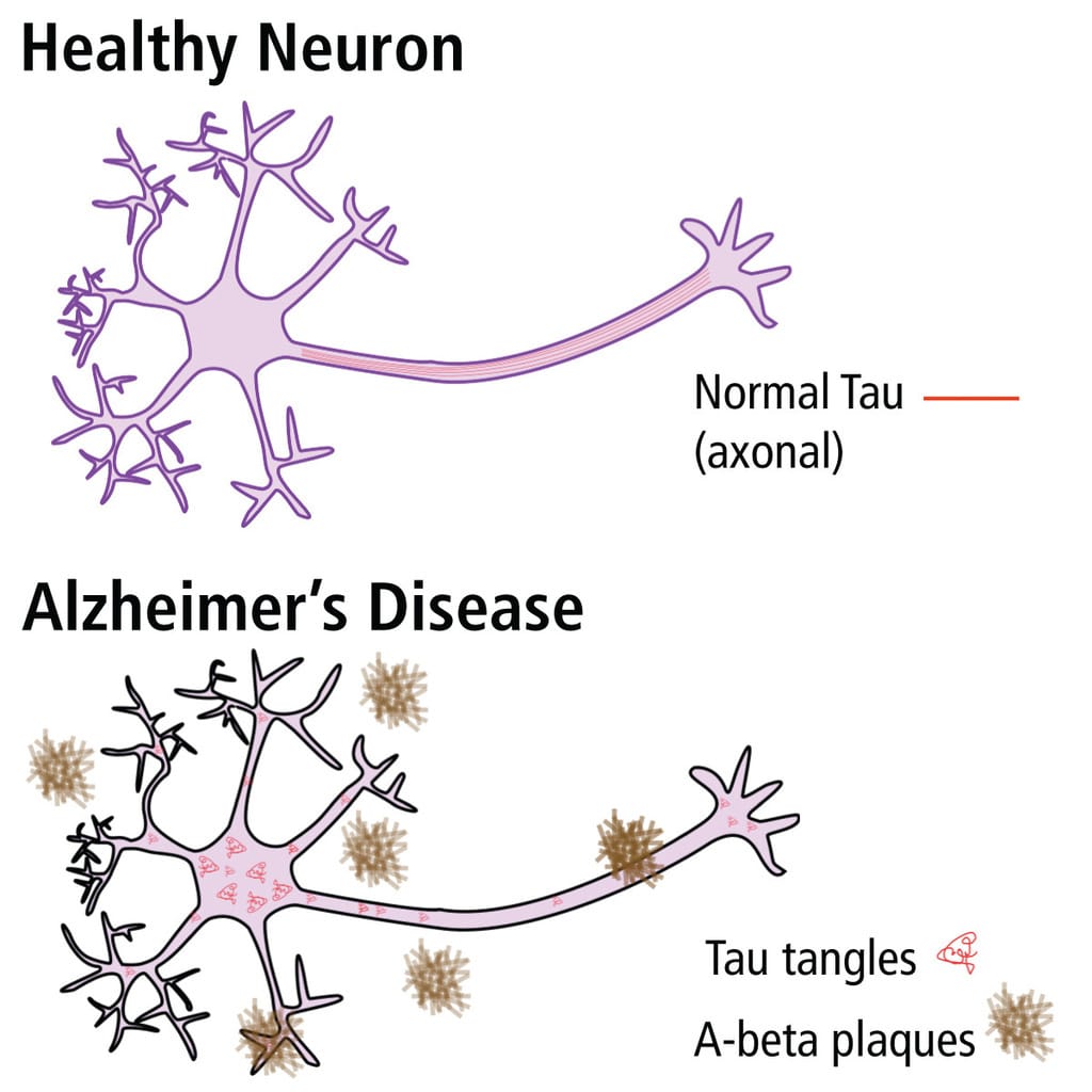Edvotek Researching Alzheimer's Disease by ELISA