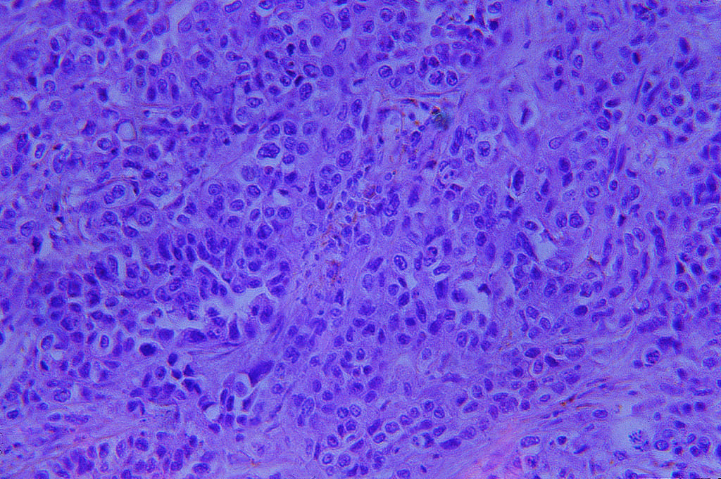 Lung Carcinoma Slide