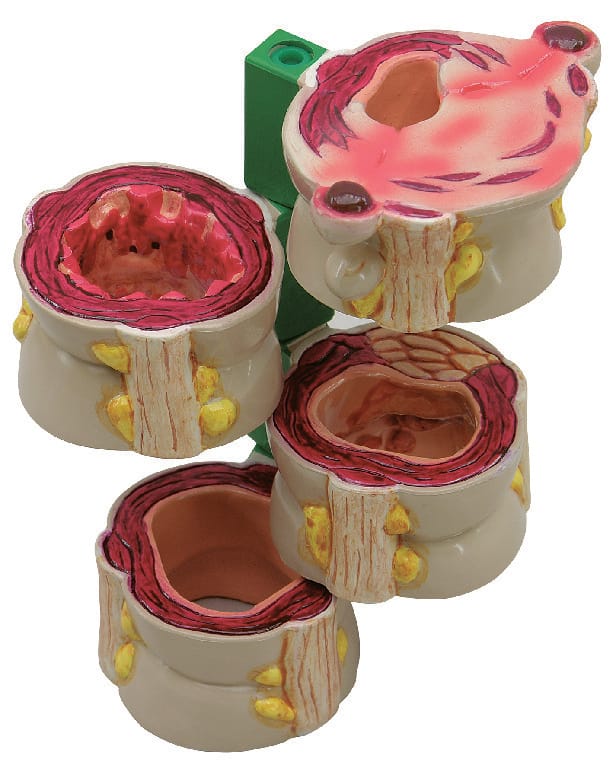 GPI Anatomicals® Colon Pathology Model