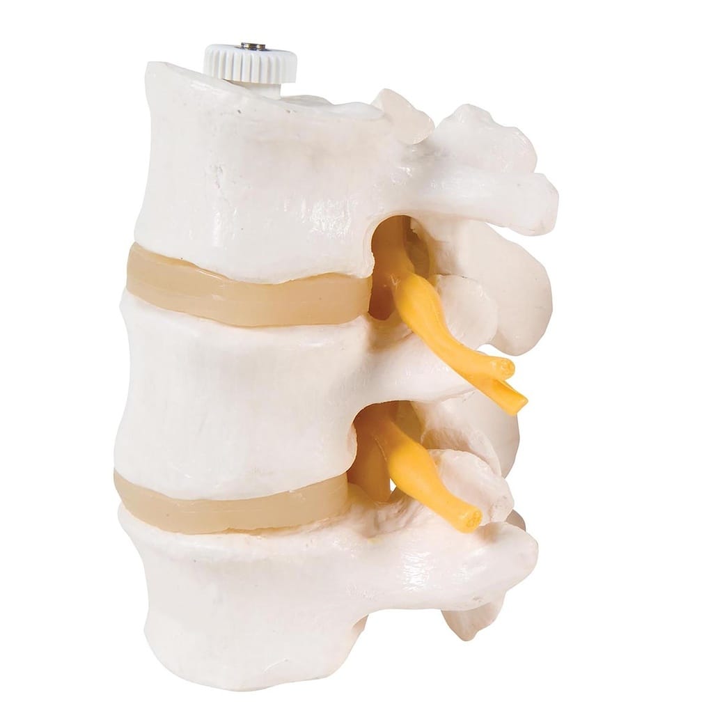 3B Scientific® Lumbar Vertebra With Prolapsed Disc Models