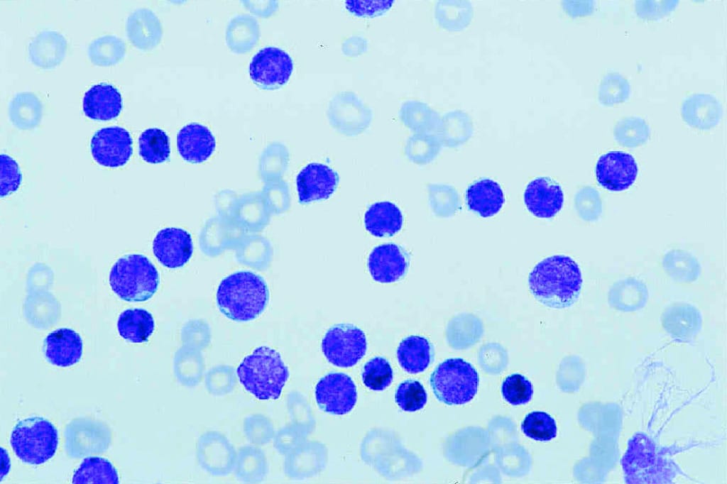 Acute Lymphatic Leukemia Slide