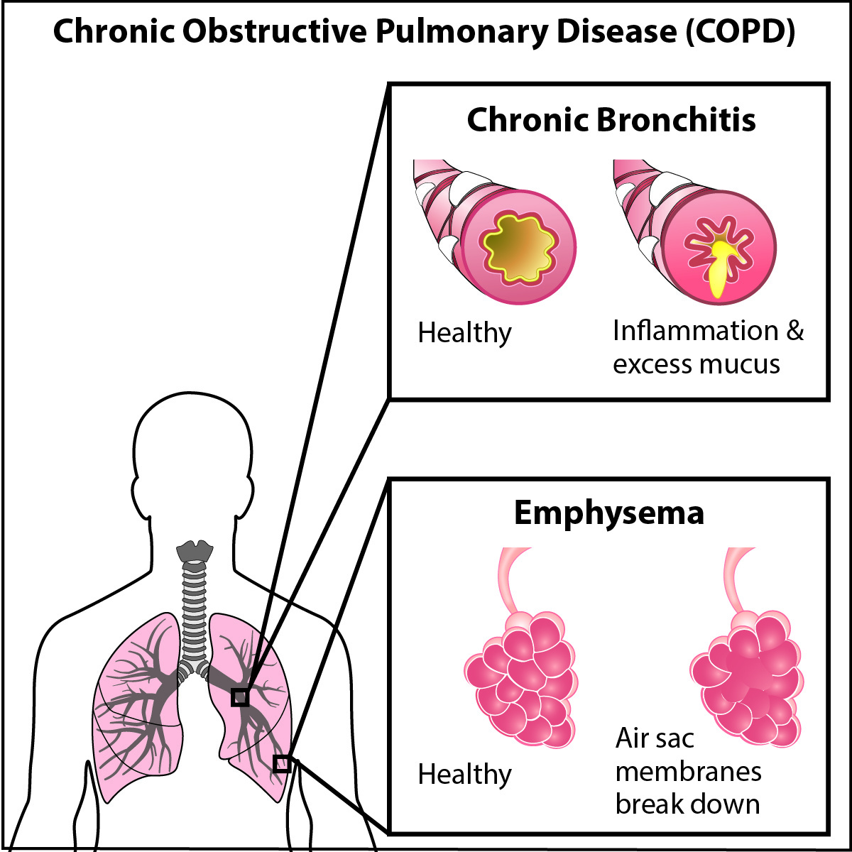 Science Take-Out® Lung Disease