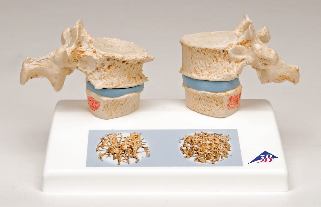 3B Scientific® Osteoporosis Model