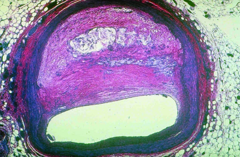 Atherosclerosis