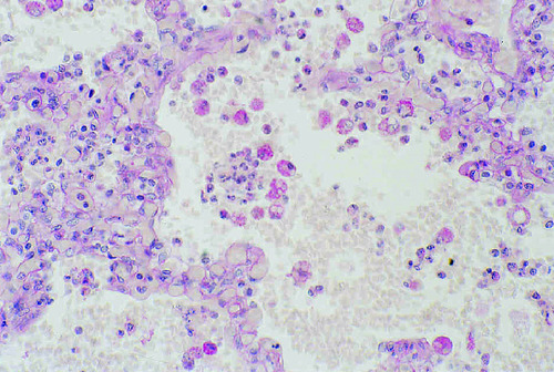 HUMAN LUNG-2ND AIDS INFECTION PAS