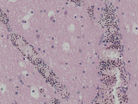 Plasmodium falciparum, Brain, Hematoxylin & Eosin Stained Section Slides