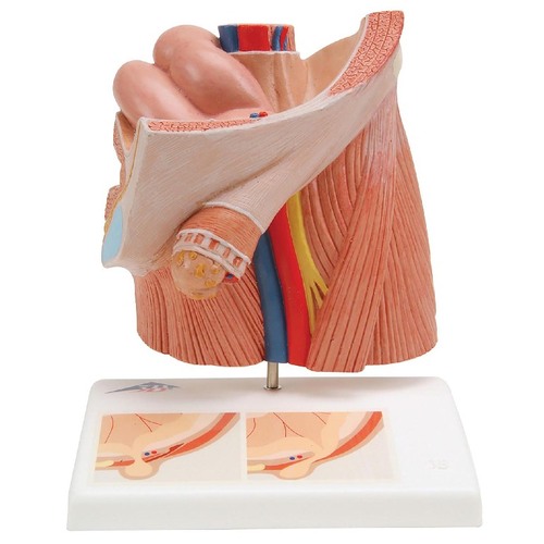 MODEL INGUINAL HERNIA