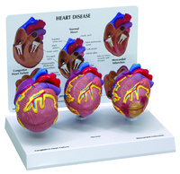 GPI Anatomicals® Heart Disease Model Set