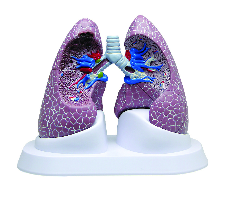 GPI Anatomicals® Lung Set with Pathologies Model | Human Biology Models