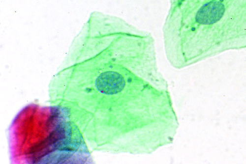 BARR BODIES (SM) CV SQUAMOUS EPITHELIAL