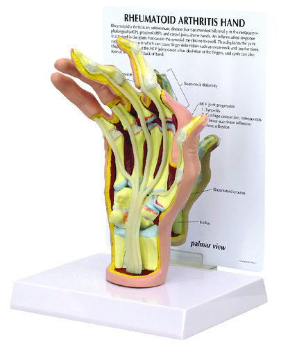 Model rheumatoidarthritis hand, size: 6x3-2/5x7-4/5IN, Card: 6-1/4x8-1/4IN, Base:6-1/2x5inch