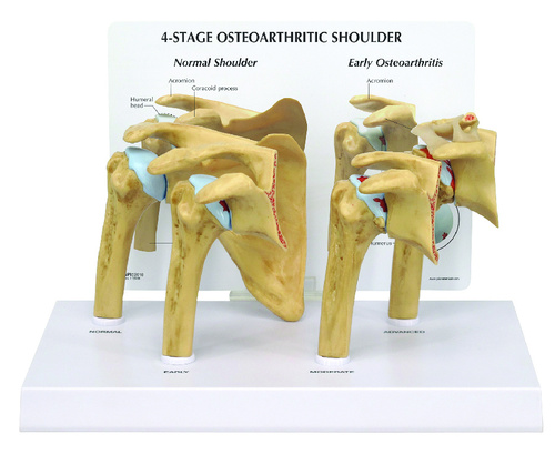 Model 4stage osteoarthritis shoulder, 4-1/2x2-1/10x4IN, Card: 8-1/4x6-1/4IN, Base:10-5/8x6-1/4in