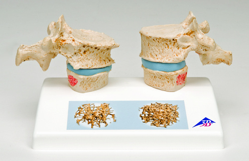 MODEL OSTEOPEROSIS SCIENTIFIC