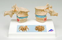 3B Scientific® Osteoporosis Model