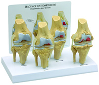 GPI Anatomicals® Stages of Osteoarthritis Knee Model