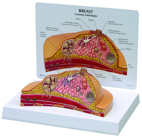 MODEL BREAST CROSS SECTION CANCE