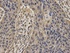 Immunohistochemical staining of paraffin embedded human esophageal cancer tissue using BRCA1 antibody (primary antibody dilution at 1:100)