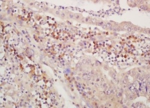 Immunohistochemical analysis of formalin-fixed paraffin embedded human gastric carcinoma tissue using PLAGL2 antibody (dilution at 1:200)